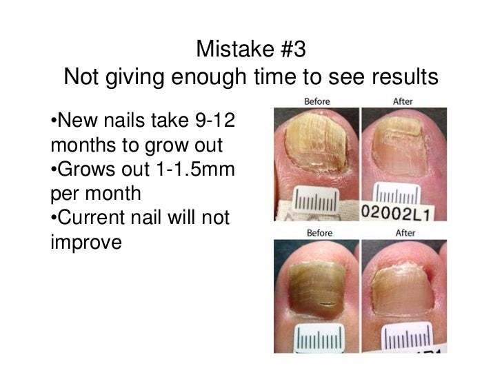 topical toenail fungus treatment topical toenail fungus treatment